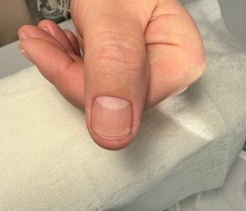 Если вместе с воздухом в подногтевую полость попадает патогенная флора, ноготь становится коричневым или зеленым, а без своевременного лечения может начаться